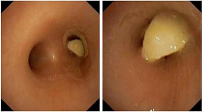 Role of Unilateral Vocal Cord Palsy in Causing Recurrent Tracheobronchial <mark class="highlighted">Foreign Bodies</mark>